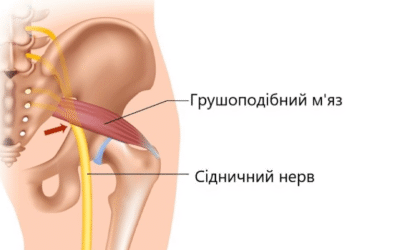 Синдром грушоподібного м’яза: як він пов’язаний із хребтом