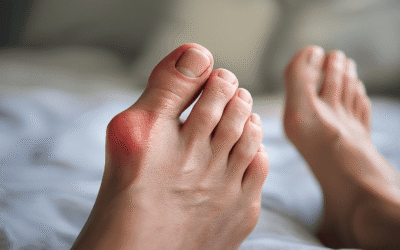Кістка на нозі (hallux valgus): чому вона росте