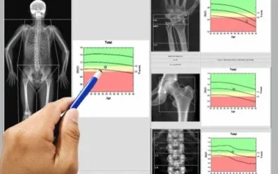 Як перевірити щільність кісток за допомогою денситометрії