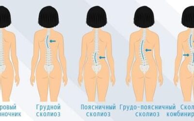 Чому при сколіозі у дітей з’являється різна висота лопаток.